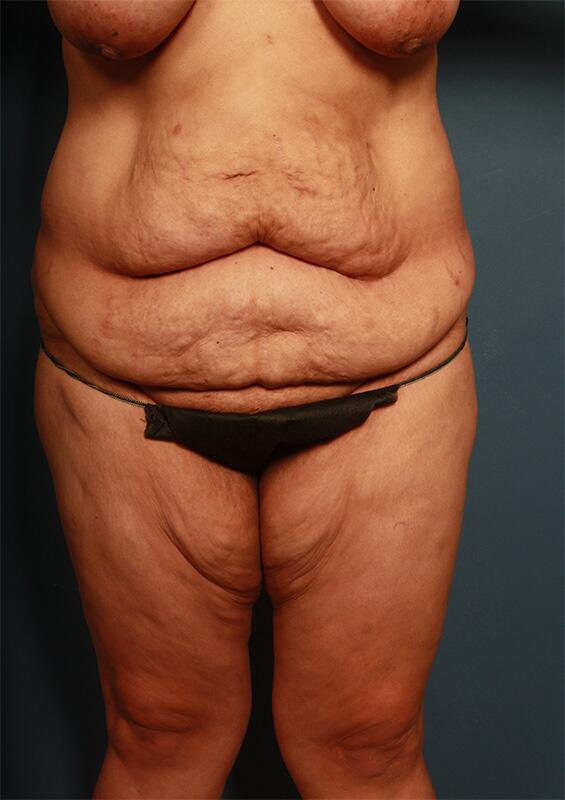 Panniculectomy Before & After Image