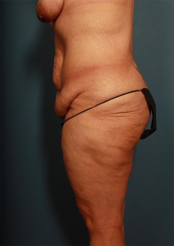 Panniculectomy Before & After Image