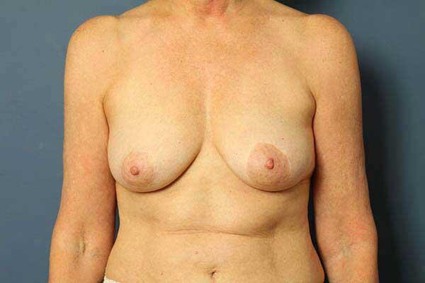 Periareolar Breast Lift Before & After Image