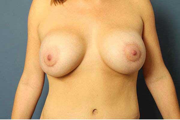 Periareolar Breast Lift Before & After Image