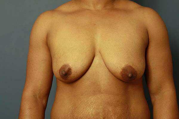 Periareolar Breast Lift Before & After Image