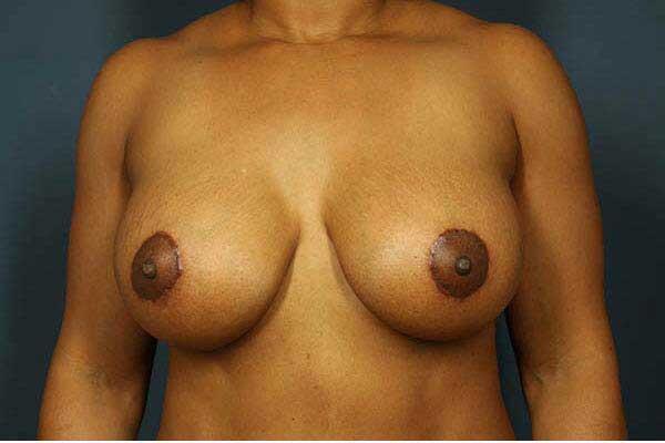 Periareolar Breast Lift Before & After Image