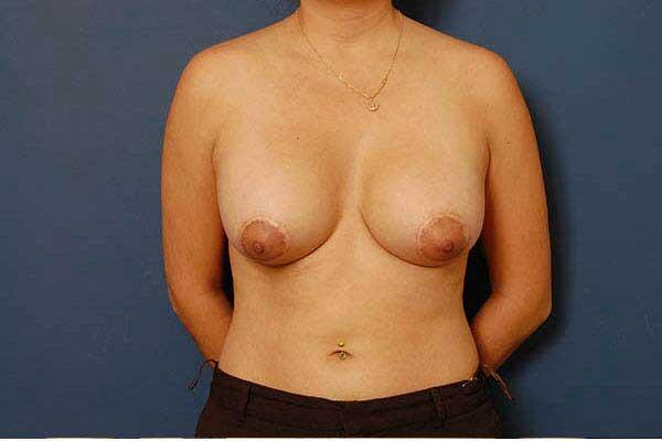 Periareolar Breast Lift Before & After Image