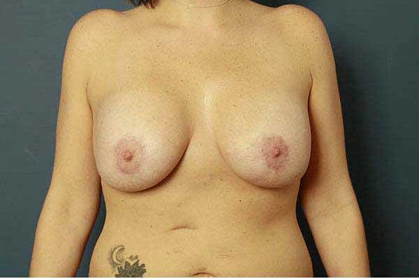 Periareolar Breast Lift Before & After Image