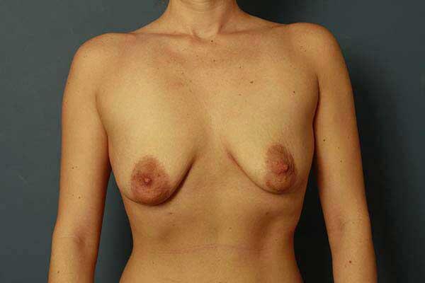 Periareolar Breast Lift Before & After Image