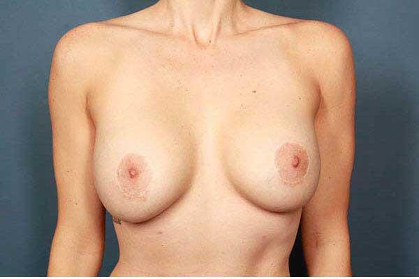 Periareolar Breast Lift Before & After Image