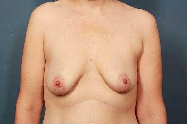 Periareolar Breast Lift Before & After Image