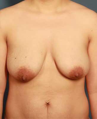 Periareolar Breast Lift Before & After Image