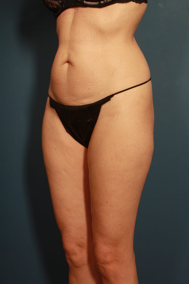 Tummy Tuck Before & After Image