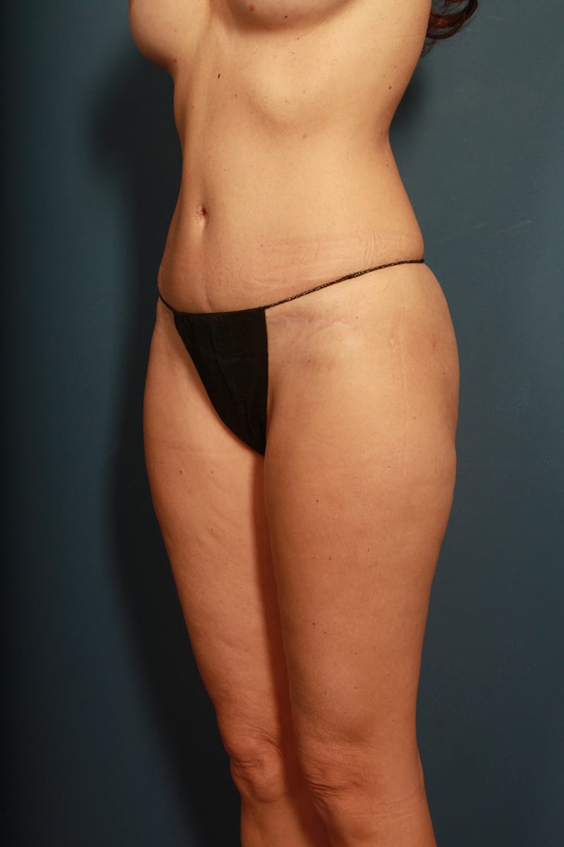 Tummy Tuck Before & After Image