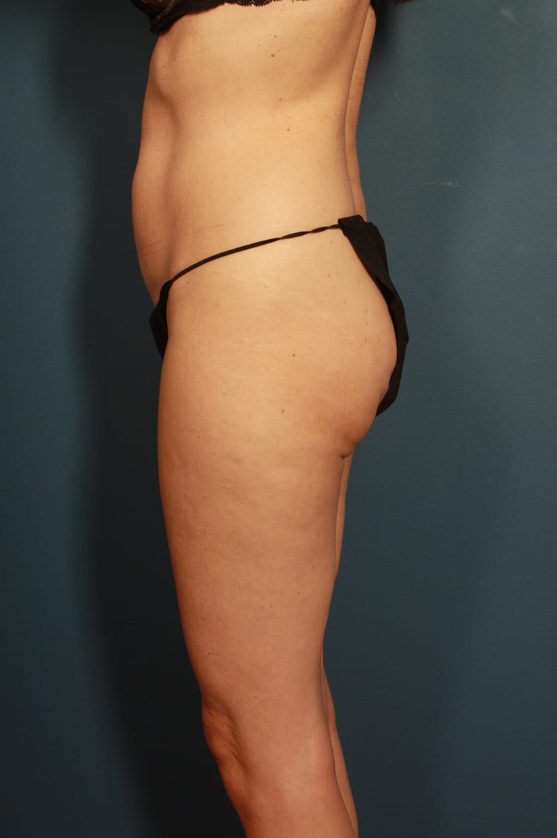 Tummy Tuck Before & After Image