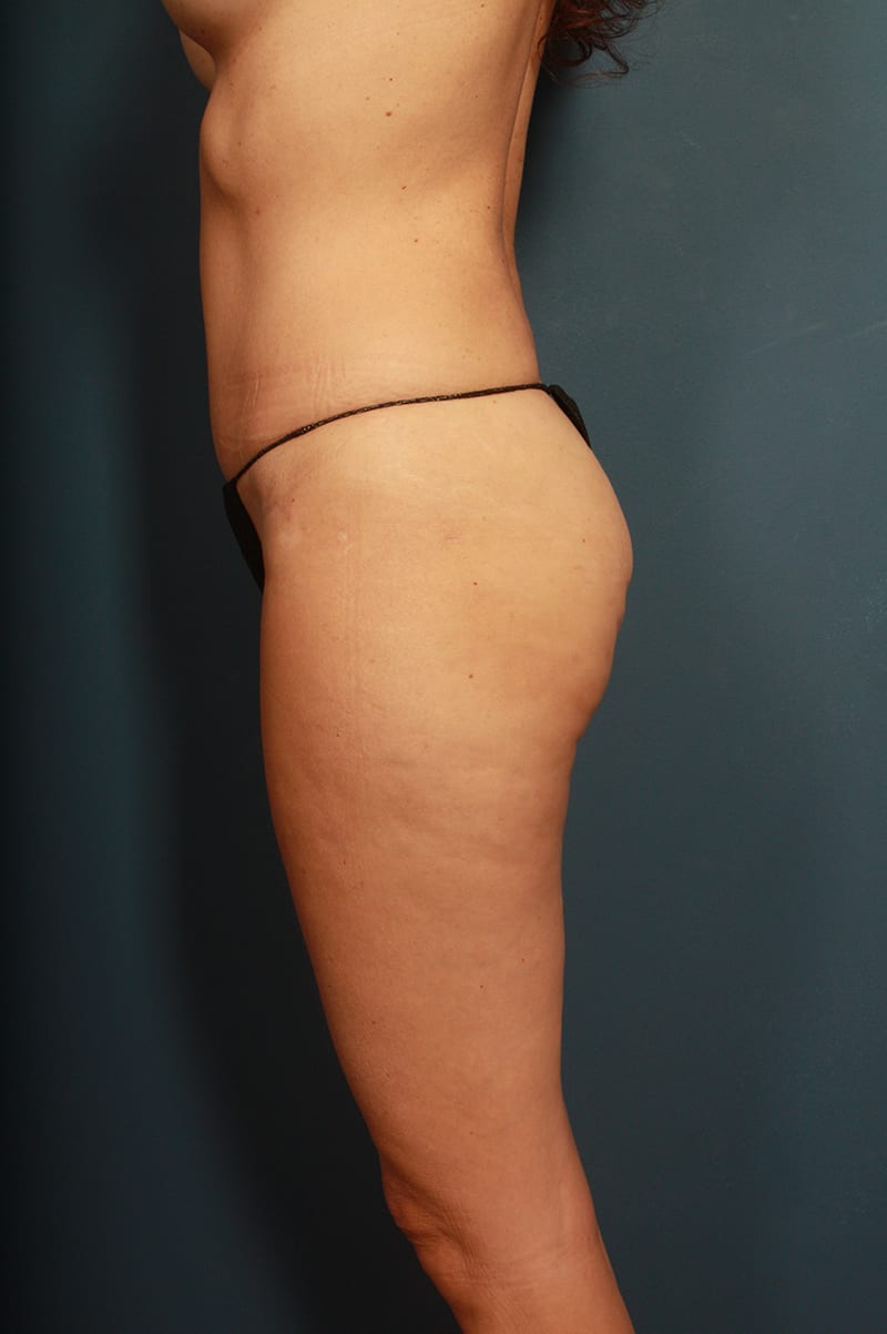 Tummy Tuck Before & After Image