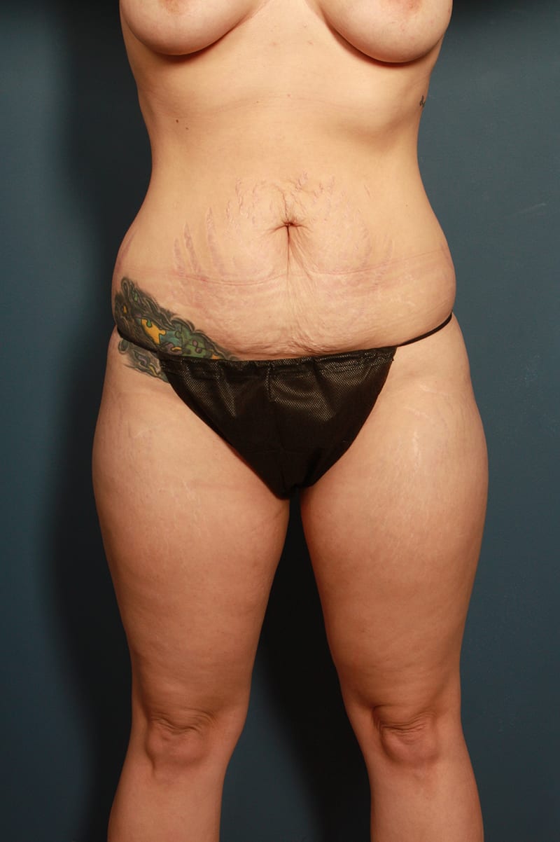 Tummy Tuck Before & After Image