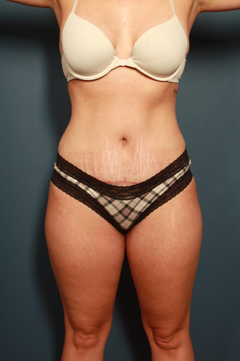 Tummy Tuck Before & After Image