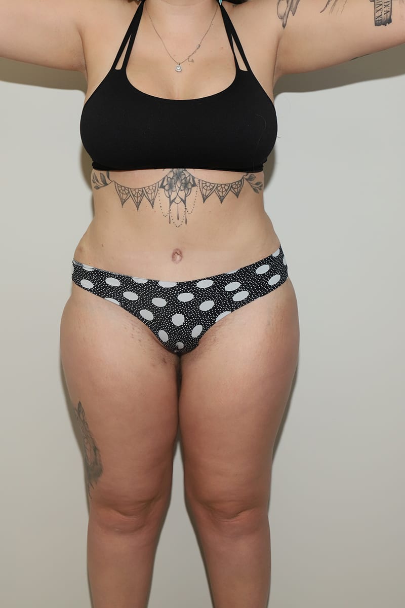 Tummy Tuck Before & After Image