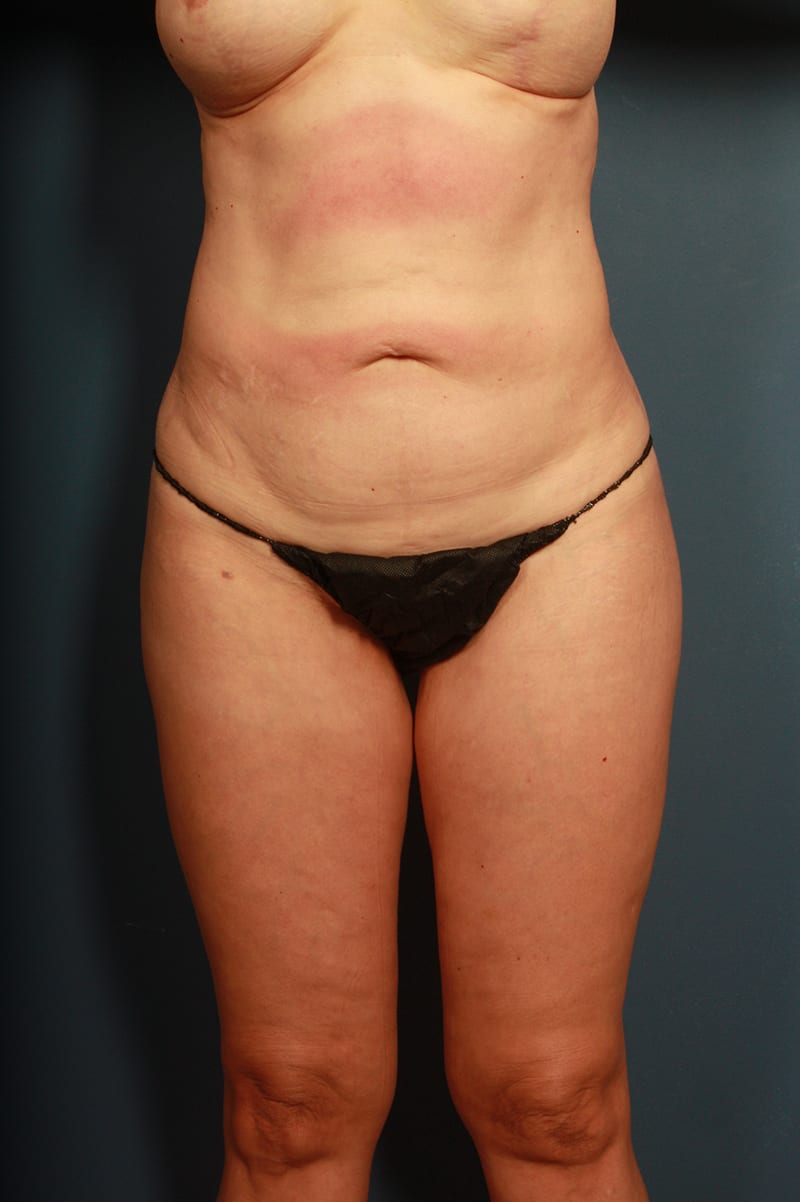 Tummy Tuck Before & After Image