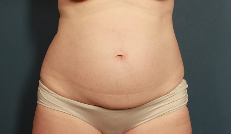 Tummy Tuck Before & After Image