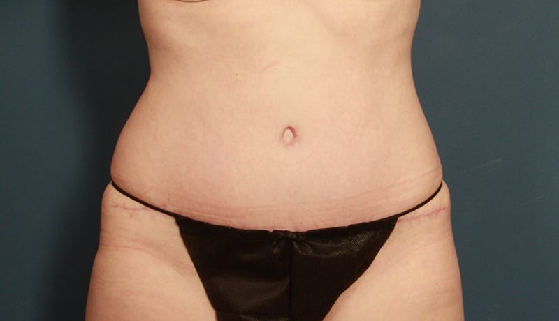 Tummy Tuck Before & After Image