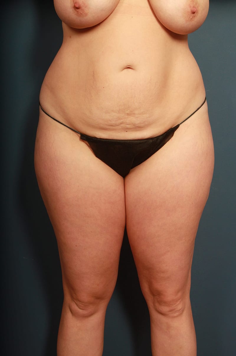 Tummy Tuck Before & After Image