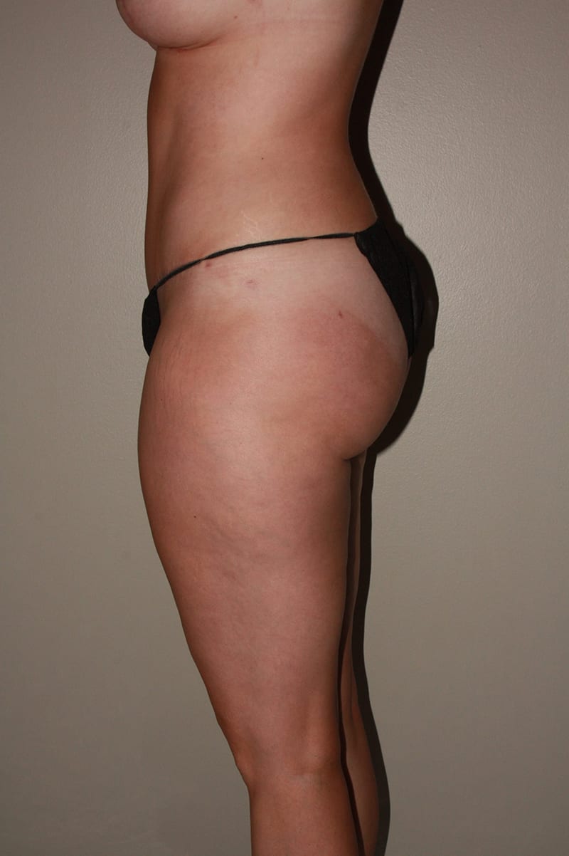 Tummy Tuck Before & After Image