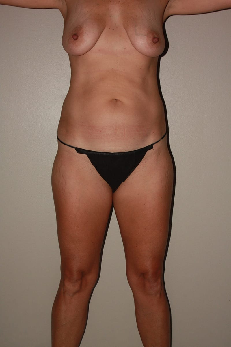 Tummy Tuck Before & After Image