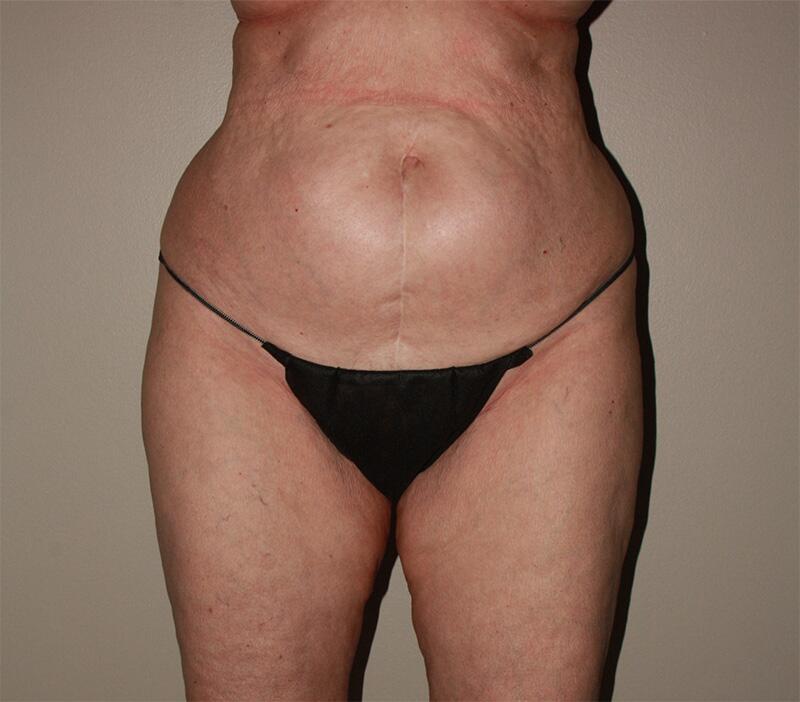 Tummy Tuck Before & After Image