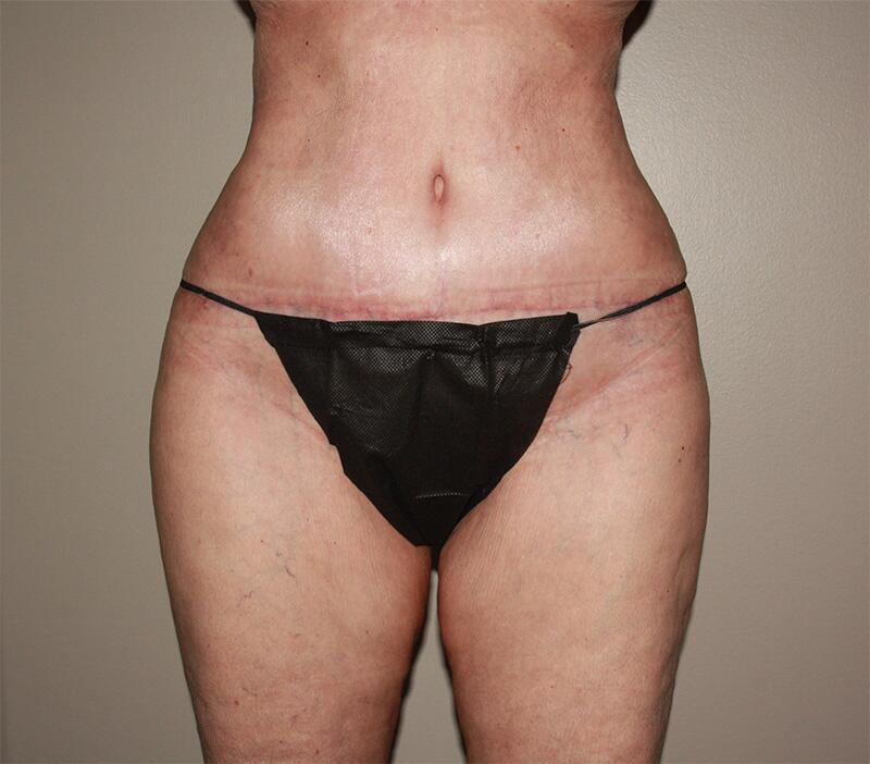 Tummy Tuck Before & After Image