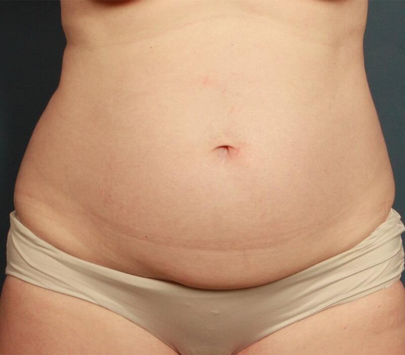 Tummy Tuck Before & After Image