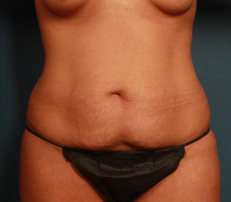 Tummy Tuck Before & After Image