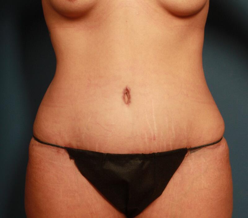 Tummy Tuck Before & After Image