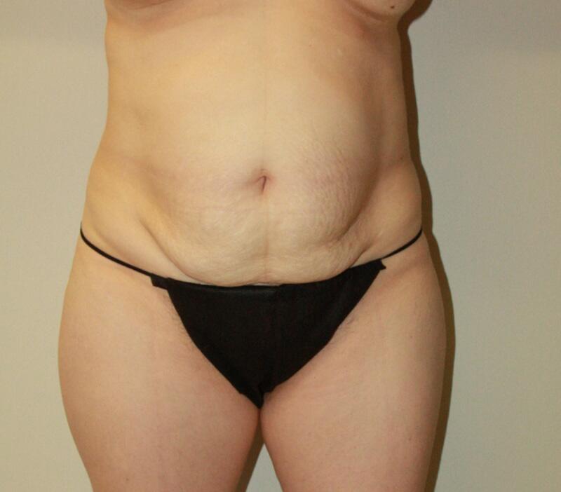 Tummy Tuck Before & After Image