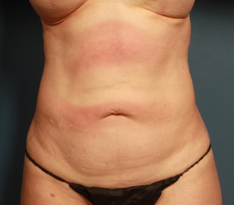 Tummy Tuck Before & After Image